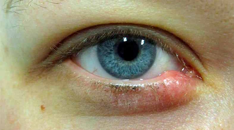 Qué son los orzuelos en los ojos y cómo prevenirlos